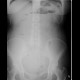 Carcinoma of transverse colon, ileus, perforation of bowel, peritonitis: X-ray - Plain radiograph